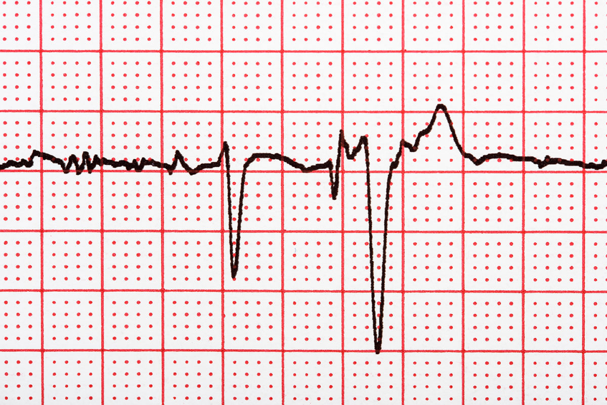 Extrasystole On Electrocardiogram Record Paper