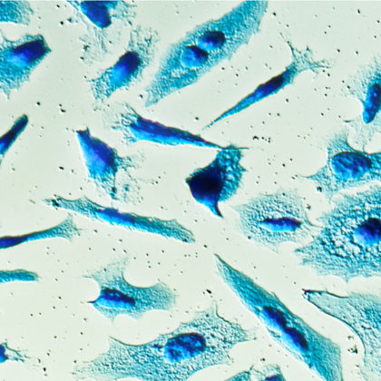 First Trial Shows Benefit for Genomically Targeted Prostate Cancer Treatment