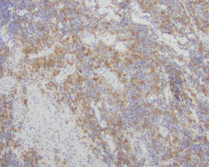 Gene Implicated in Poor Skin Cancer Therapy Outcomes