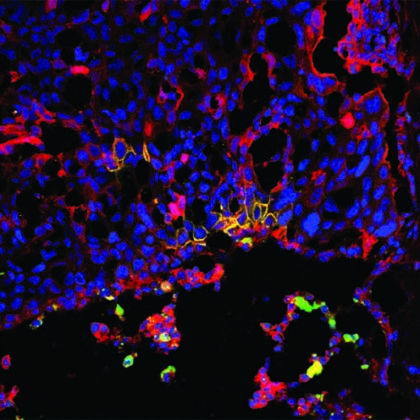 Neural Stem Cell Therapy May Improve Metastatic Cancer Survival