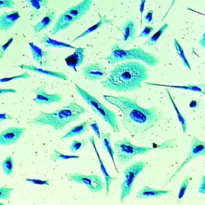 New Treatment for Metastatic Hormone-Sensitive Prostate Cancer