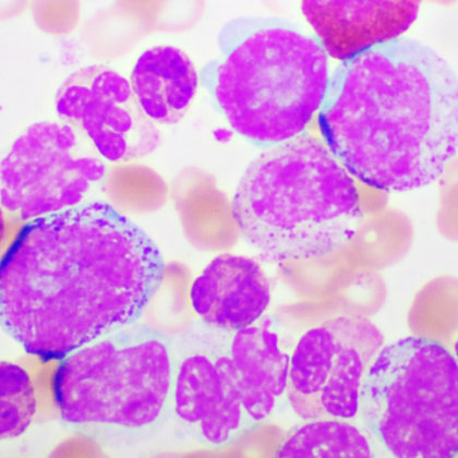 Exploring Novel Mechanisms and Therapeutic Targets for Acute Myeloid Leukemia