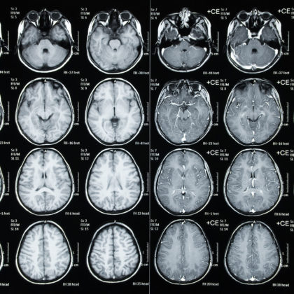 Understanding How Childhood Brain Tumors Develop