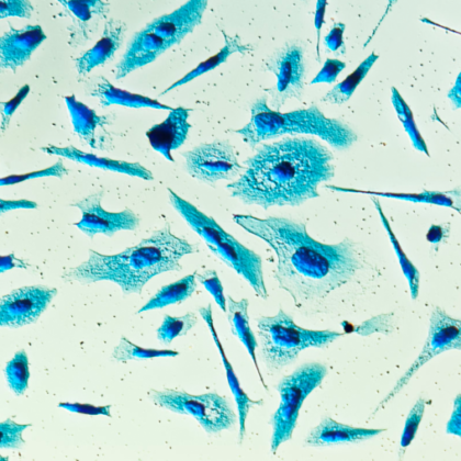 Study Uncovers Potential Therapeutic Approach for Advanced Prostate Cancer