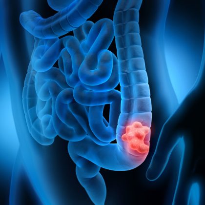 Colonoscopies Just Got Smarter