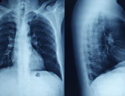 Secondary Bacterial Pneumonia Drove Many COVID-19 Deaths