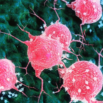 Combination Treatment Extends Survival in Advanced Bladder Cancer