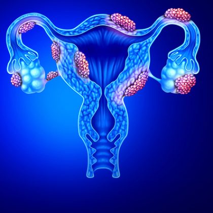 Study Identifies Racial Differences in Rare Endometrial Cancer