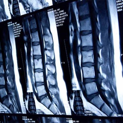 Novel Intracellular Mechanisms May Inform Treatments for Congenital Spinal Defects