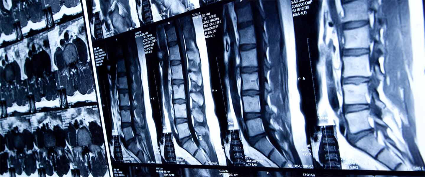 Novel Intracellular Mechanisms May Inform Treatments for Congenital Spinal Defects