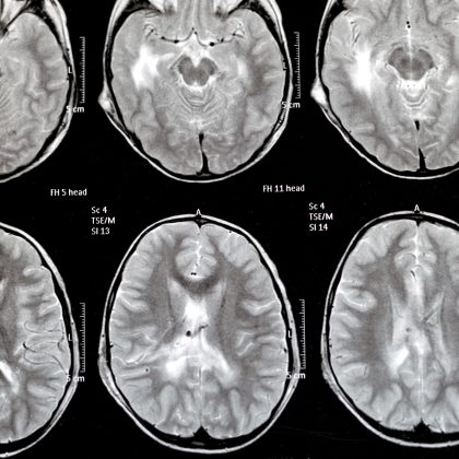 Diabetes Drug May Serve as Alternative Treatment Option for Hydrocephalus