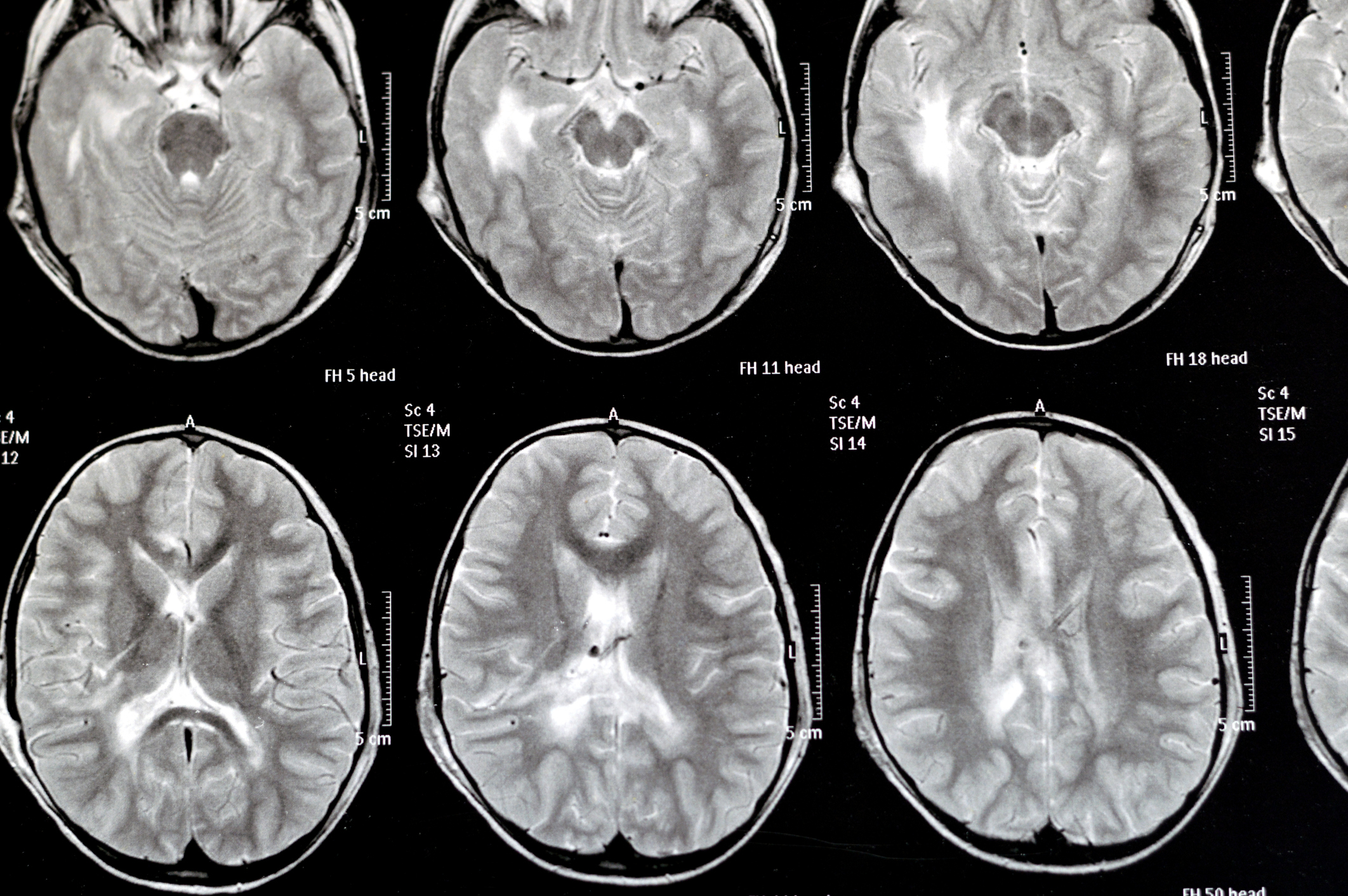 Diabetes Drug May Serve as Alternative Treatment Option for Hydrocephalus