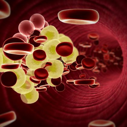 Little-Used Cholesterol Test Could Prevent More Heart Attacks, Strokes