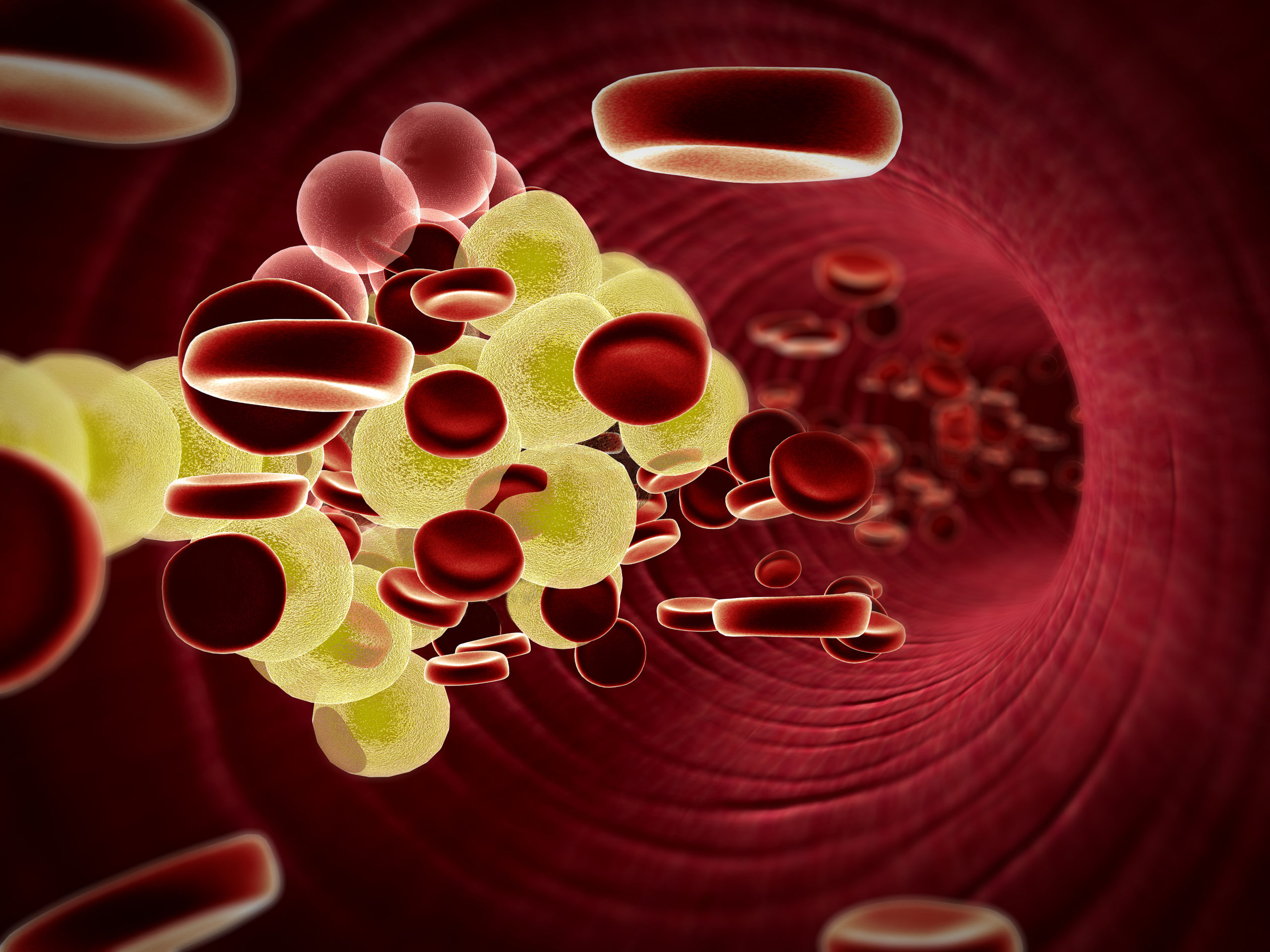 Little-Used Cholesterol Test Could Prevent More Heart Attacks, Strokes